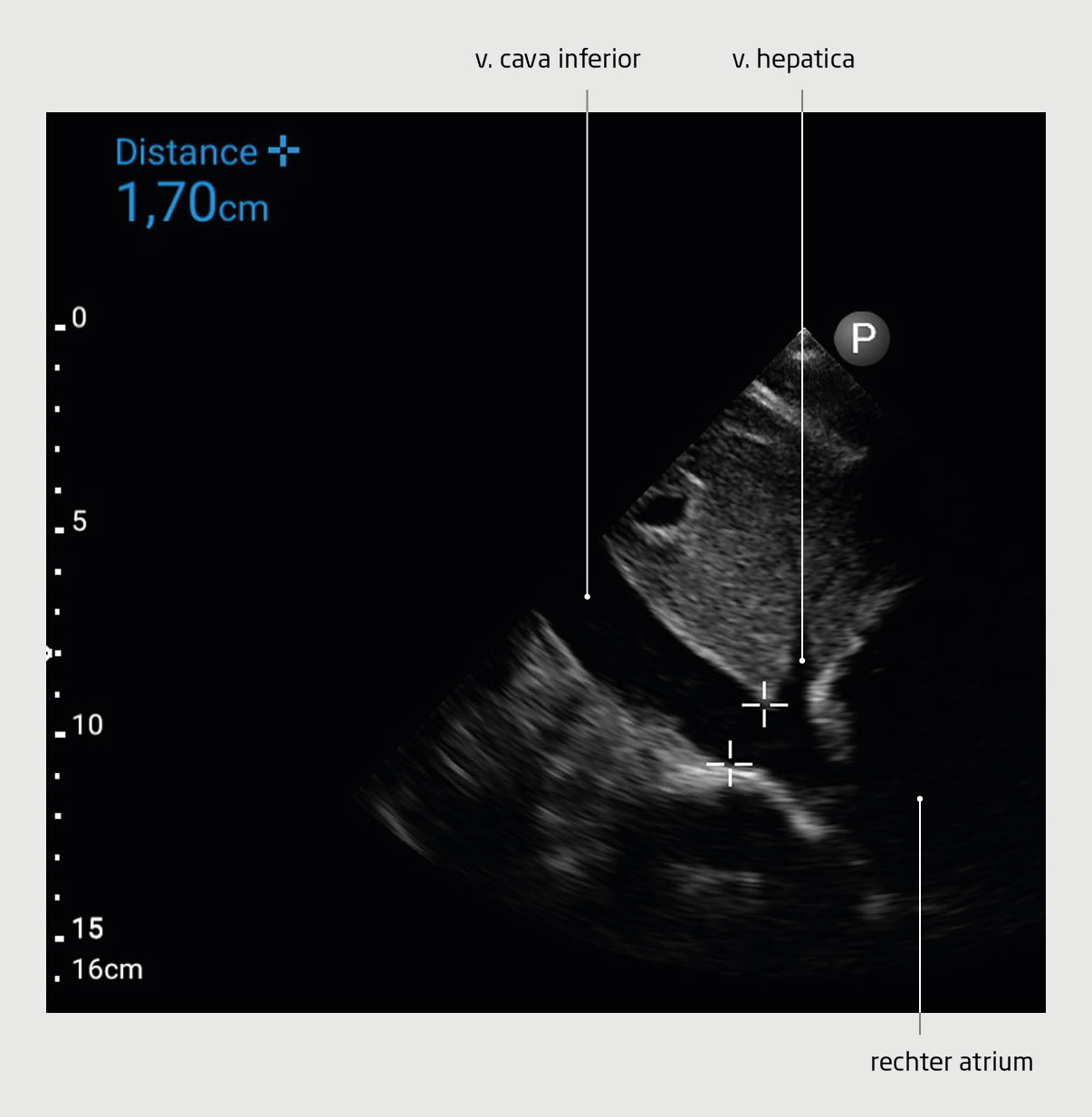 inspiratie betekenis medisch